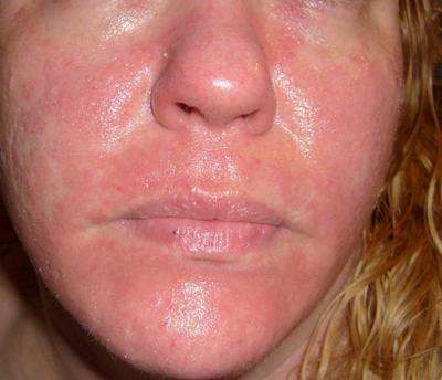 Good ??. P. reccomend Facial rashes in adults
