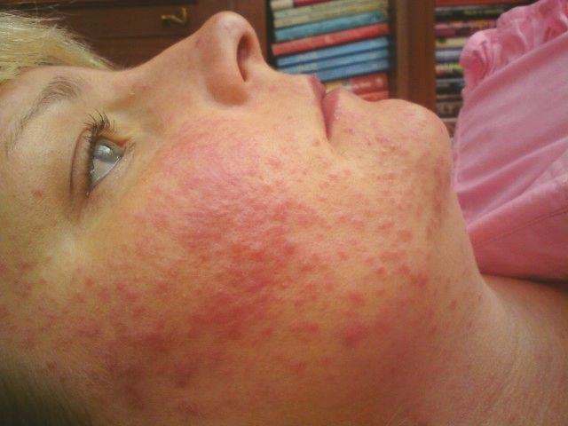 Facial rashes in adults